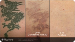 Picosure tattoo removal sydney