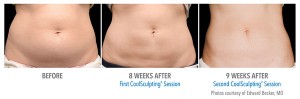 coolsculpting in sydney