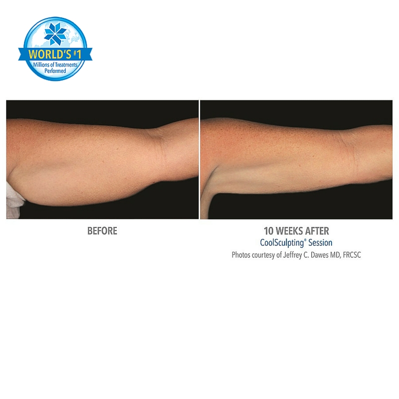 Cool Sculpting Sydney - Non Surgical Liposuction | The ...