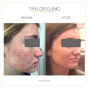 acne scar treatment in sydney